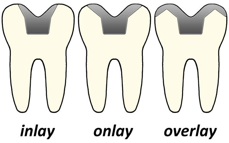 Seri Artikel Dental ‘Apa Sih Yang Dilakukan Oleh Dokter Gigi’ : Inlay, Onlay dan Overlay